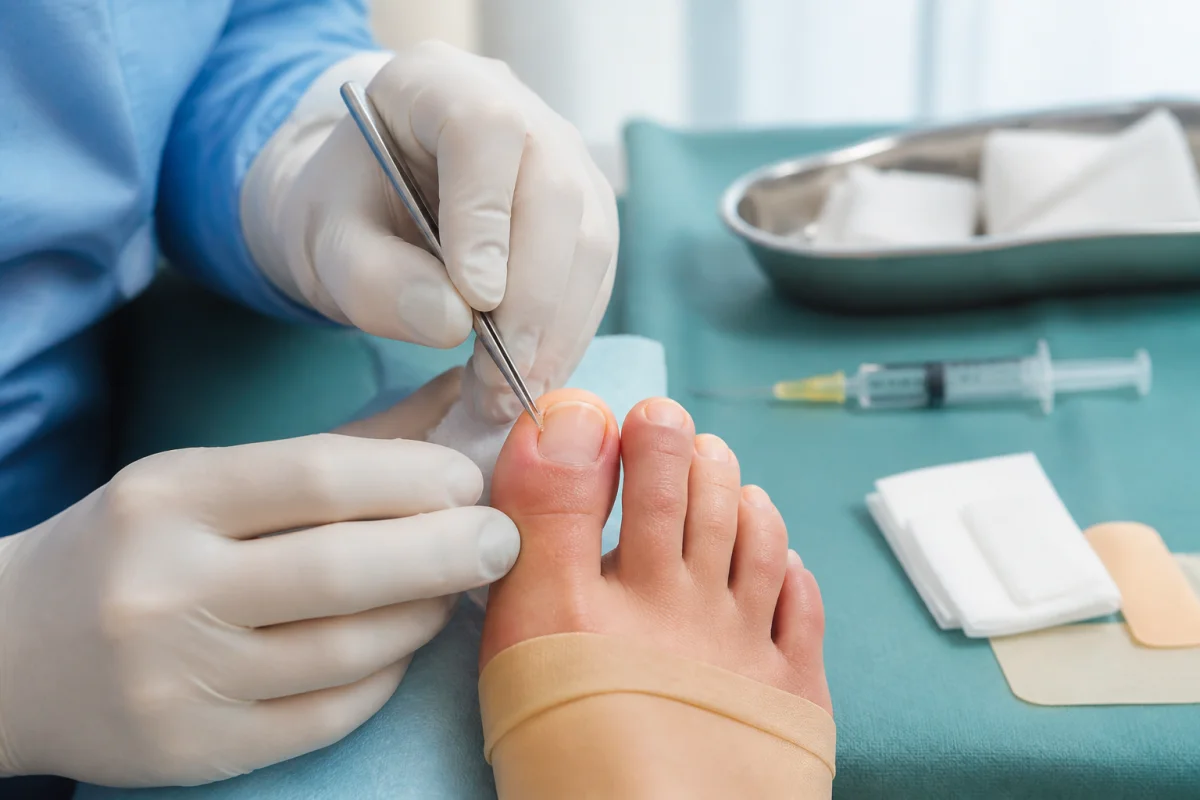 Qui opère les ongles incarnés